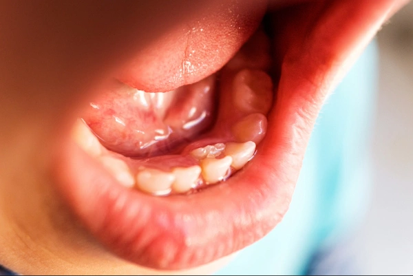Dientes inferiores izquierdos
