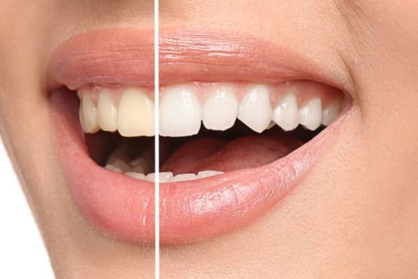 Lista de los 32 nombres de los dientes permanentes y su ubicación