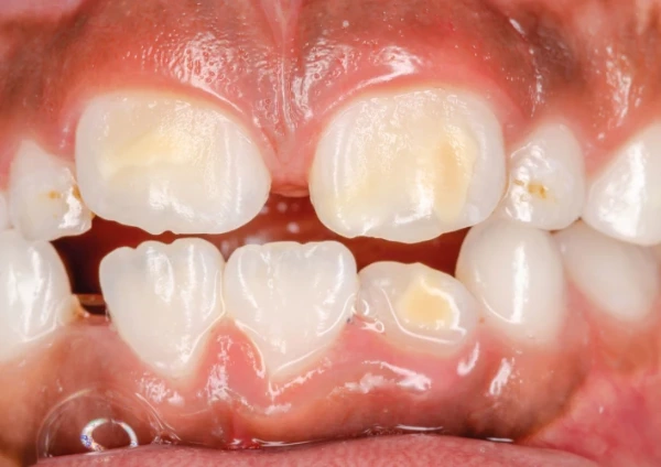 Los 10 síntomas de caries a los que debes prestar atención