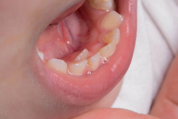 ¿Cuántos dientes permanentes tiene una persona adulta?