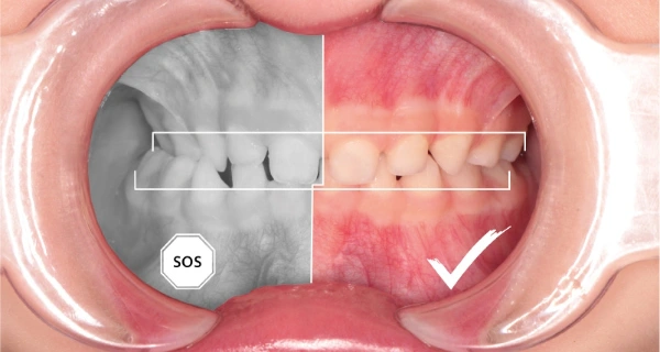 ¿Qué es la mordida dental y por qué es importante?