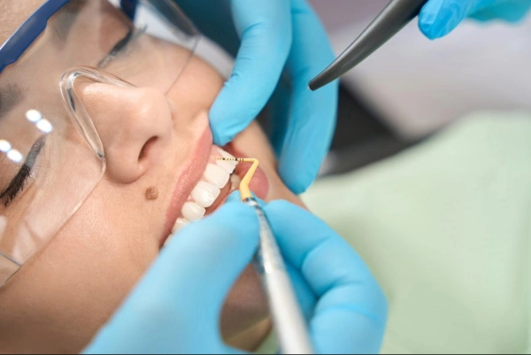 ¿Qué es una caries dental y por qué aparecen sus síntomas?
