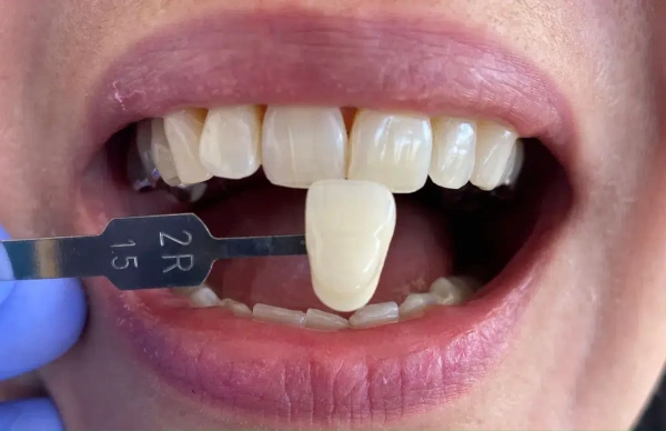 Beneficios de nuestro blanqueamiento dental
