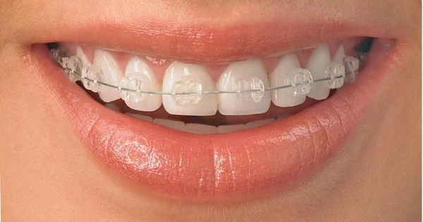 Brackets estéticos (2)