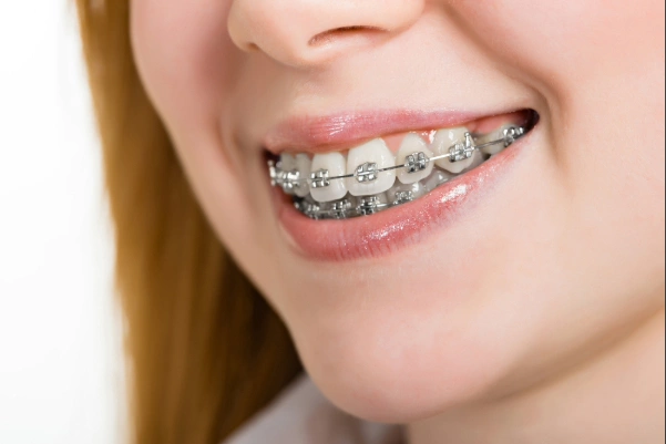 Brackets metálicos (2)