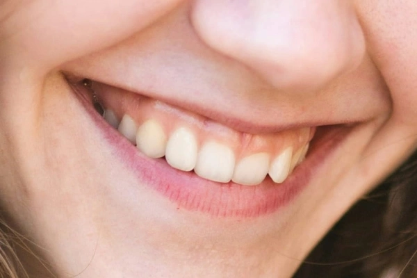 Causas comunes de la sonrisa gingival