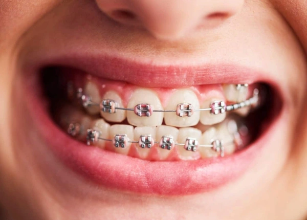 Combinaciones de colores de liga para brackets