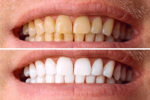 Consejos para mantener tu sonrisa