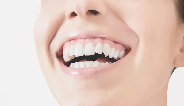 Factores de riesgo asociados a la sonrisa gingival