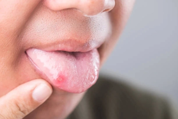 Heridas en la lengua 7 causas y cómo tratarlas