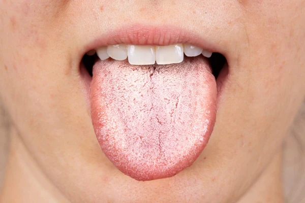 Lengua blanca qué es y cómo tratarla en 5 pasos