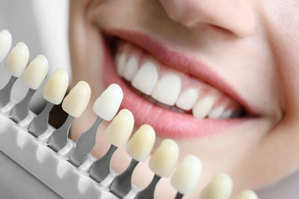 Lo que nos distingue con nuestro blanqueamiento dental