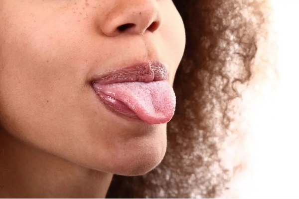 Remedios caseros para la lengua blanca