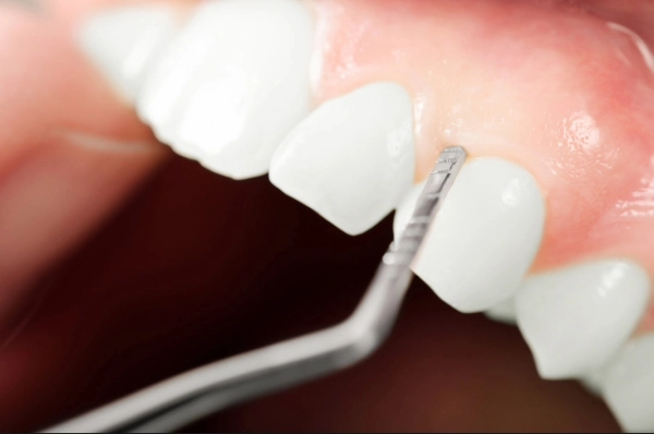 Tratamientos disponibles para la sonrisa gingival