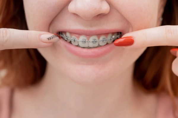 ¿Qué colores de liga hacen que los dientes se vean más blancos?