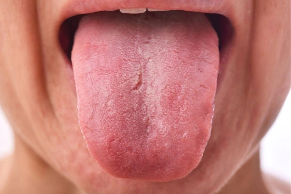 ¿Qué es exactamente la lengua blanca y por qué aparece?