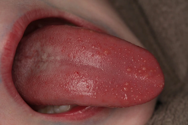 ¿Qué son las heridas en la lengua y cómo identificarlas?