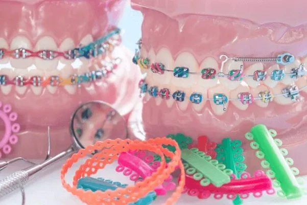 ¿Qué son las ligas de colores en los brackets y para qué sirven?
