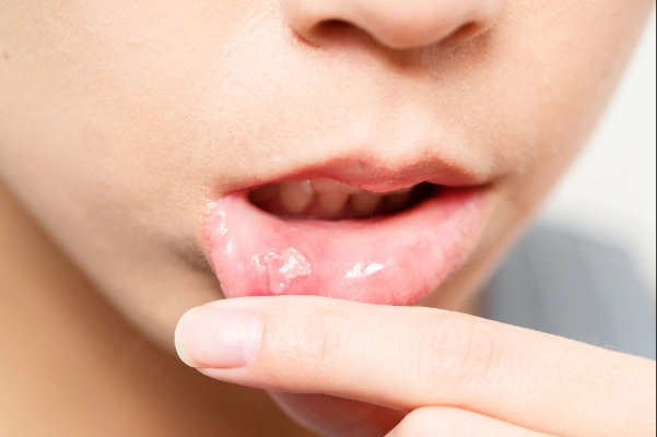 10 causas de las aftas bucales