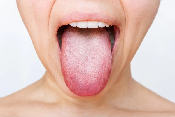 10. Lengua gris: una alteración poco frecuente que no debe ignorarse