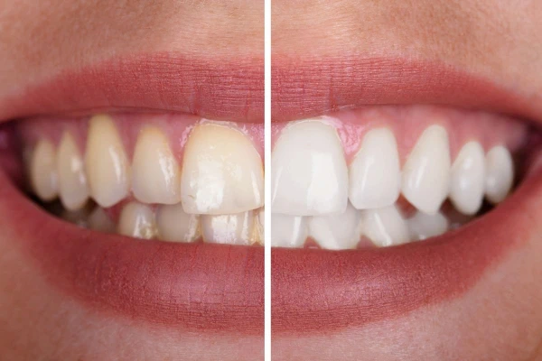 10. Mantén expectativas realistas sobre los resultados del blanqueamiento dental
