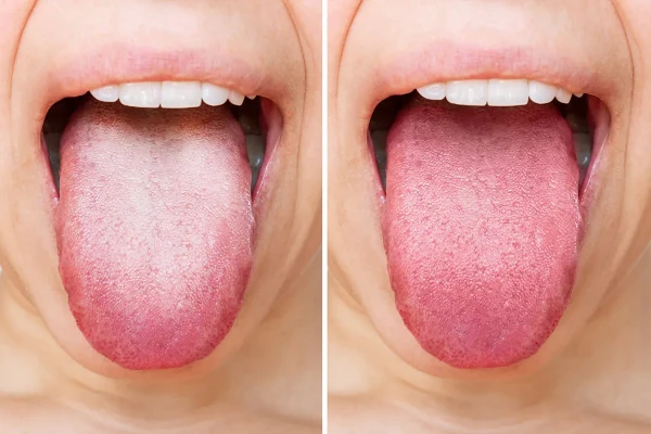 5. Lengua naranja: un cambio poco frecuente, pero generalmente temporal