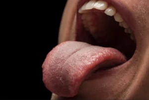 Granos en la lengua 5 tipos, causas y remedios