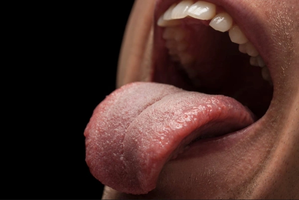 Granos en la lengua 5 tipos, causas y remedios