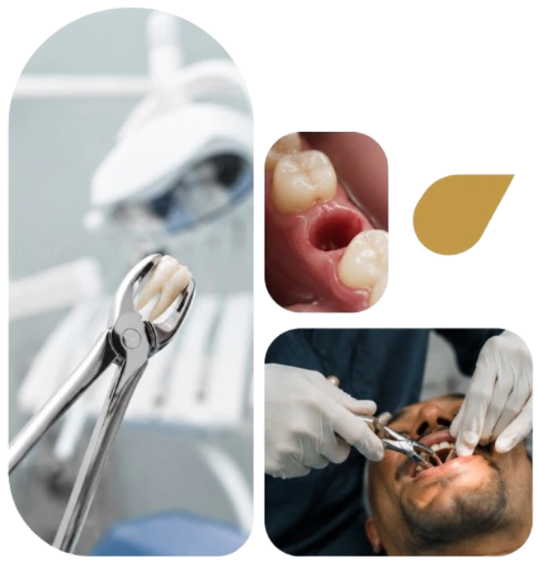 Preguntas frecuentes sobre exodoncia dental