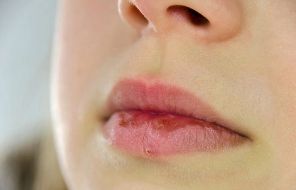 ¿Cuándo acudir al médico por un herpes labial?