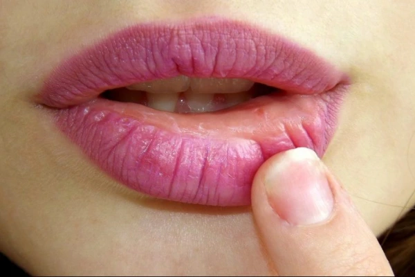 ¿Qué es un herpes labial?